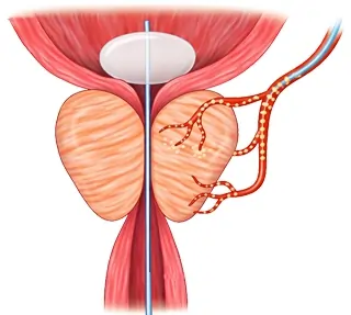 ProstateArteryEmboilsationmainpic