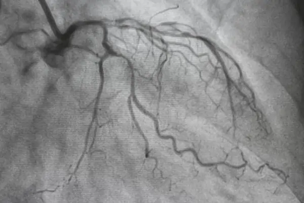 angiographyreport-cabgsurgery