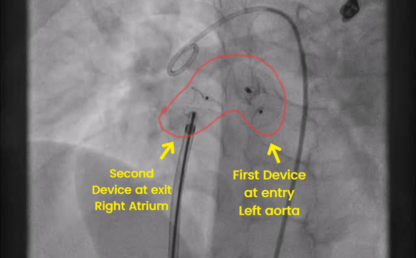 Aorto Camral Fitsula
