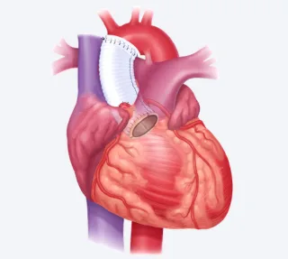 Bentall Procedure
