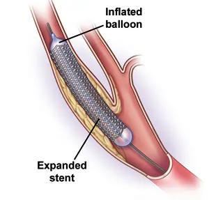 Carotid Artery Stenting
