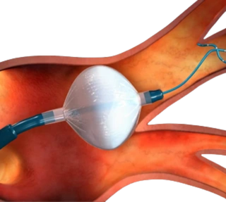 Cryoablation Procedure Mumbai