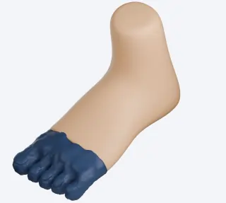 Diabetic Foot Gangrene1