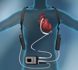 Lvad