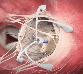 Mitral Valve Repair Replacement Surgery