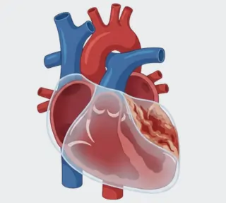 Pericardial Disease