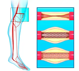 Peripheral Angioplasty Leg Pad Treatment