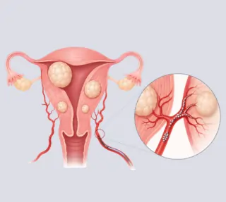 Uterinefibroidembolization Hvshospitals