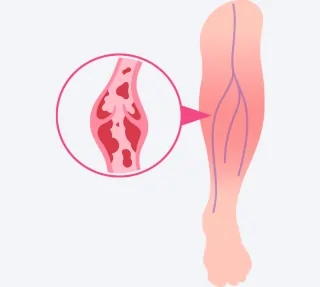Varicose Veins