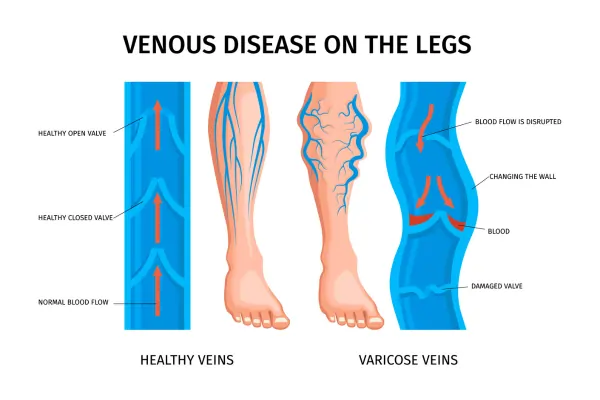 venousdiseaseonlegs-varicoseveins