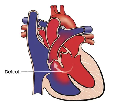 VentricularSeptal